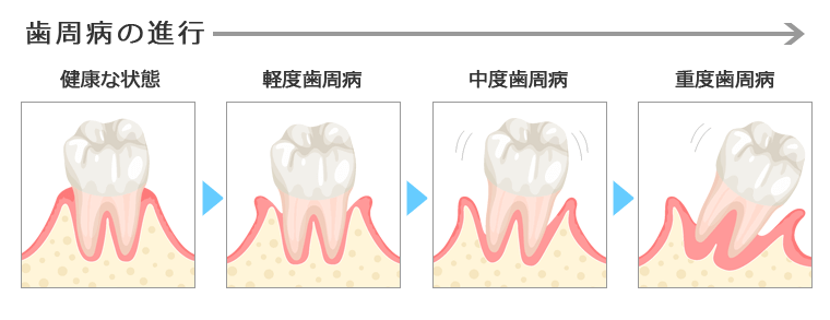 歯周病進行の説明図