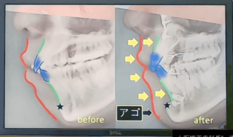 セットバック手術後のアゴについて