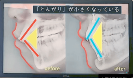 上下の歯が作るとんがりが小さくなった