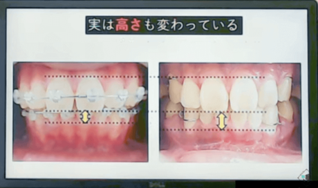 背っとバック手術で高さも変わっている