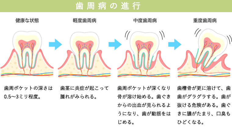 歯周病の進行