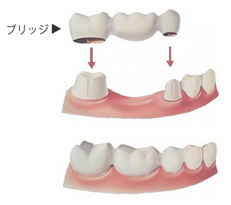 ブリッジ