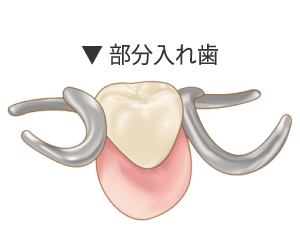 部分入れ歯