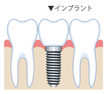 インプラント