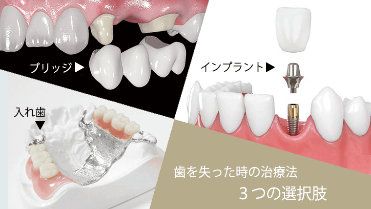 歯を失った時の治療法3つの選択肢