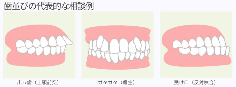 歯並びの代表的な相談例
