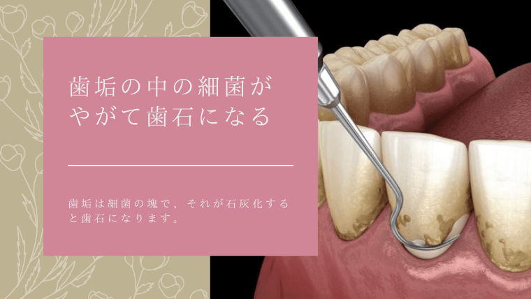 歯垢の中の細菌がやがて歯石になる