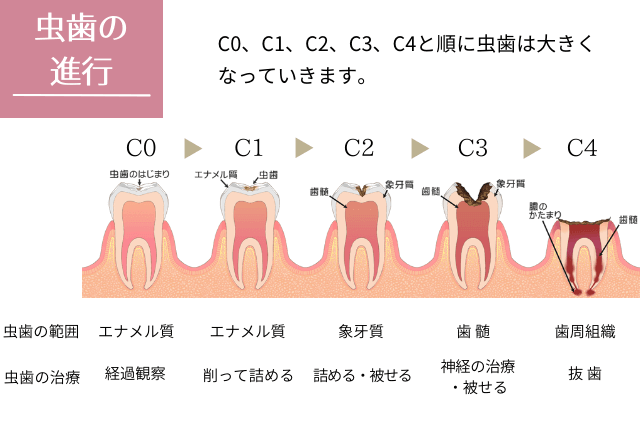 虫歯の進行