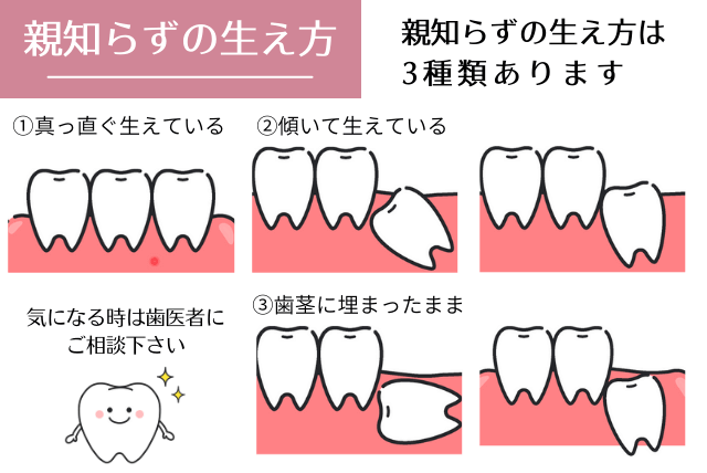 親知らず きれいに 生える