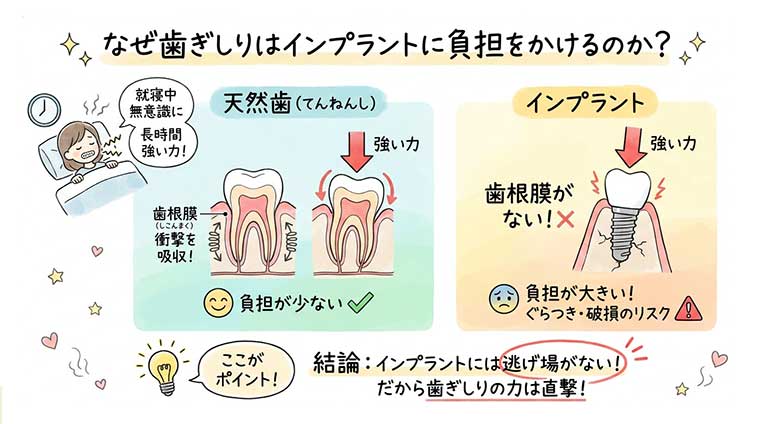 なぜ歯ぎしりはインプラントに負担をかけるのか？の図解