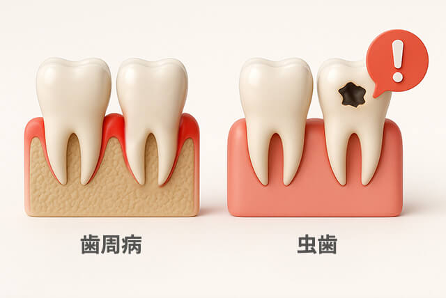 虫歯・歯周病