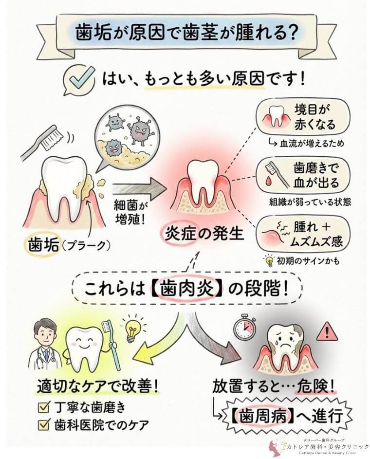 歯垢が原因で歯茎が腫れることはありますか？