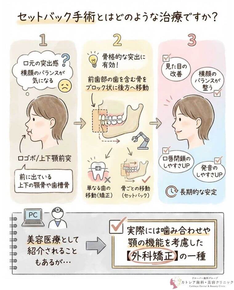 セットバック手術とはどのような治療ですか？