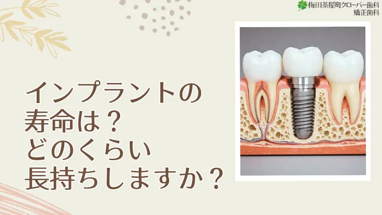 インプラントの寿命は？どのくらい長持ちしますか？