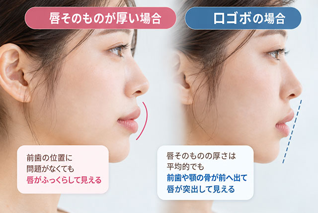 自分の唇が厚く見える原因