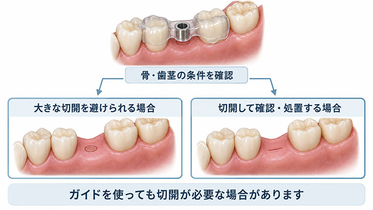 サージカルガイドを使っても切開が必要な場合もある
