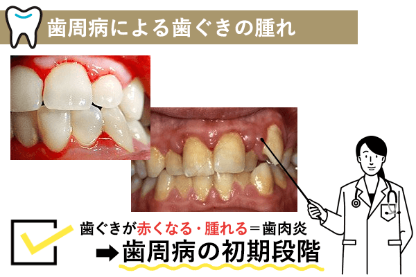 歯周病による歯ぐきの腫れ