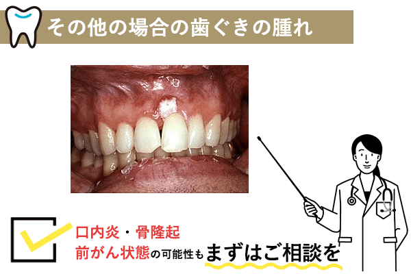 根尖病巣による歯ぐきの腫れ