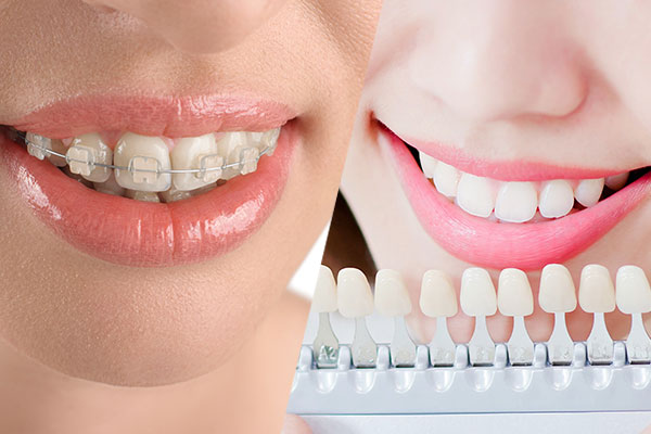 セラミック矯正とワイヤー矯正