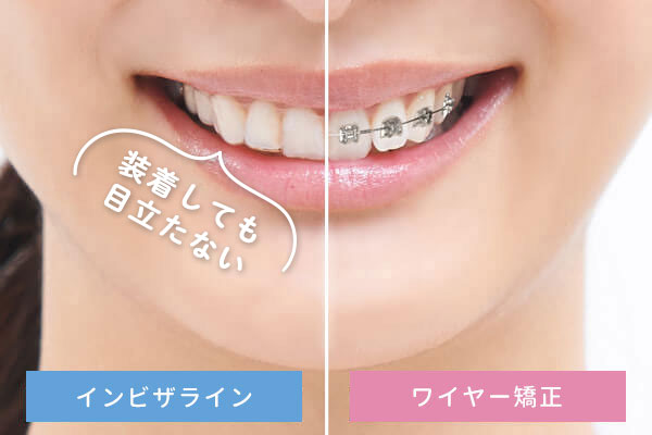 インビザライン