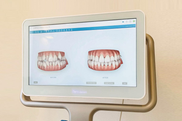 シミュレーションソフト「クリンチェック」