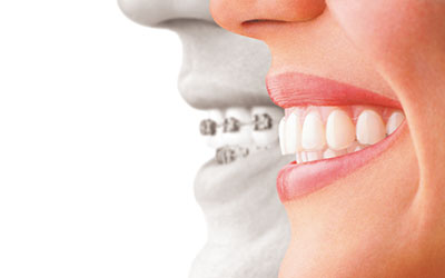 インビザライン・ワイヤー併用