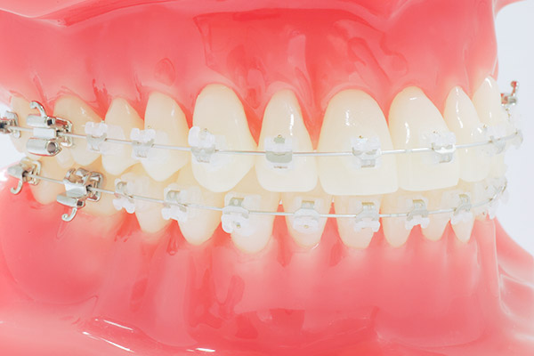 ワイヤー矯正(表側矯正)
