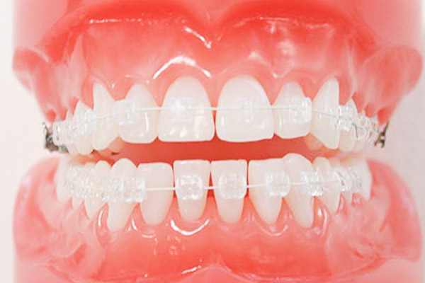 ホワイトワイヤー矯正(審美矯正)