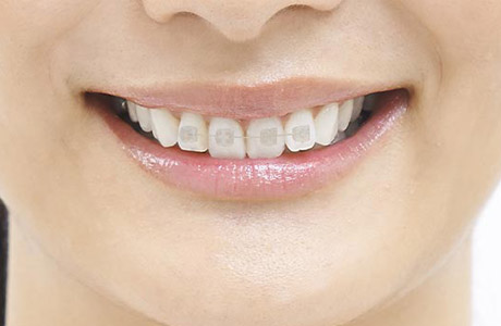 インビザライン部分矯正