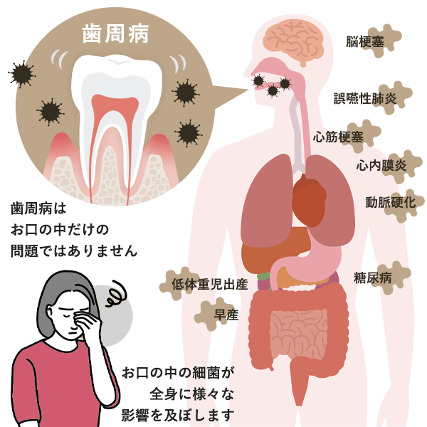 歯周病が全身に与える影響